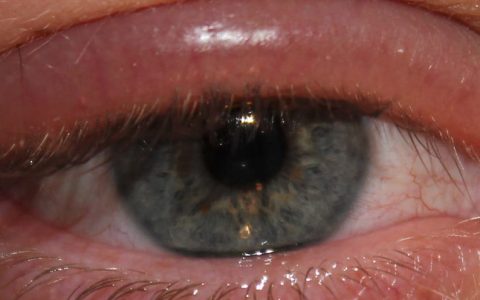 Blepharitis