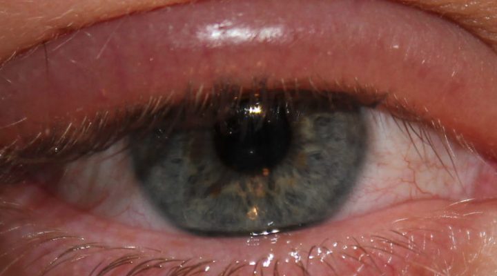 Blepharitis